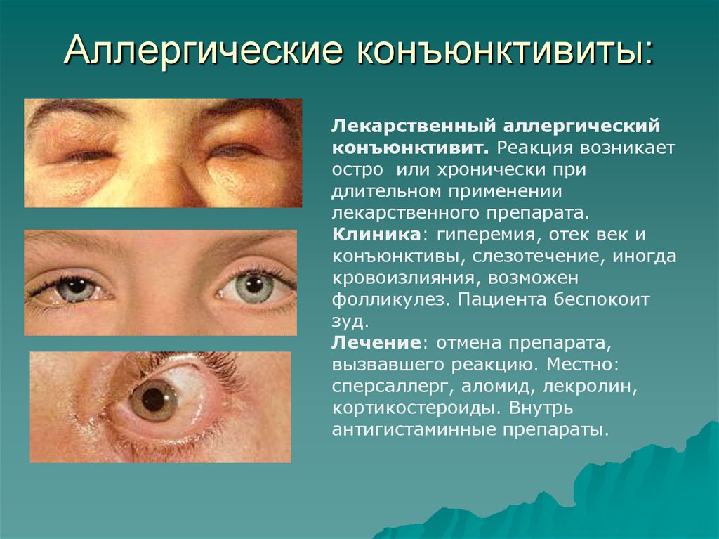 Для лечения заболевания глаз применяют 0.5. Основные клинические проявления аллергического конъюнктивита. Симптомы конъюнктивита глаз. Гнойное воспаление глаз. Конъюнктивит воспаление.