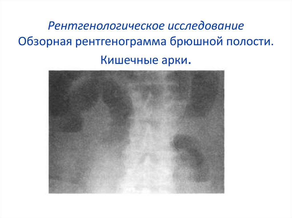 Кишечная непроходимость рентген. Арки при кишечной непроходимости рентген. Арки при кишечной непроходимости. Чаши Клойбера на рентгенограмме характерны для. Рентген описание брюшной полости при кишечной непроходимости.