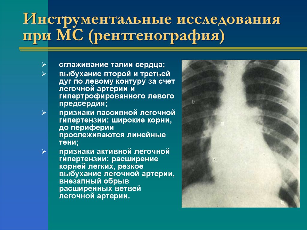 Талия сердца