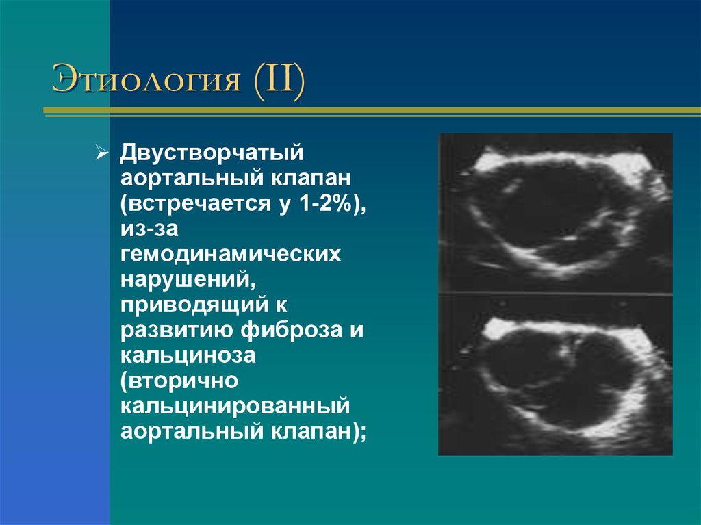 Двухстворчатый аортальный 1. ВПС 2 створчатый аортальный клапан. Функционально 2 створчатый аортальный клапан. Двухстворчатый аортальный клапан на ЭХОКГ. 2 Створчатый аортальный клапан на УЗИ.