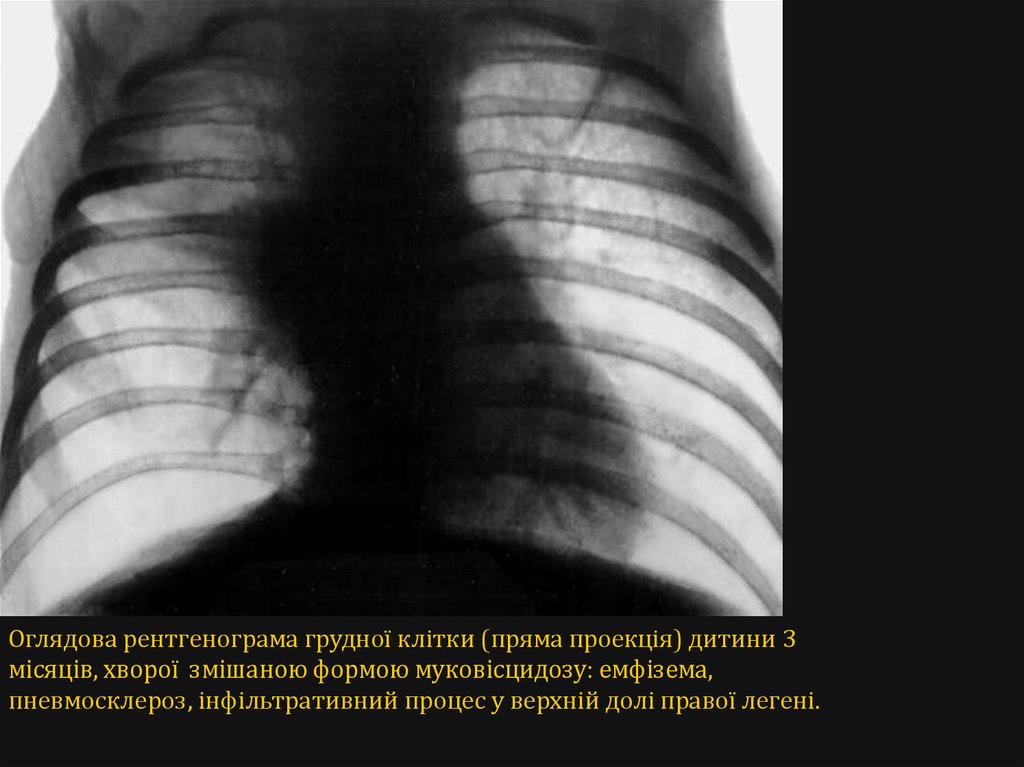 Фиброз у детей. Муковисцидоз рентгенологическая картина. Пневмосклероз рентгенограмма. Пневмосклероз верхних долей лёгких. Муковисцидоз грудная клетка.