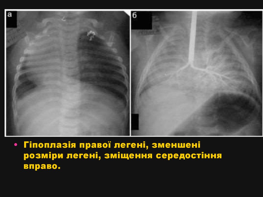 Гипоплазия легкого фото