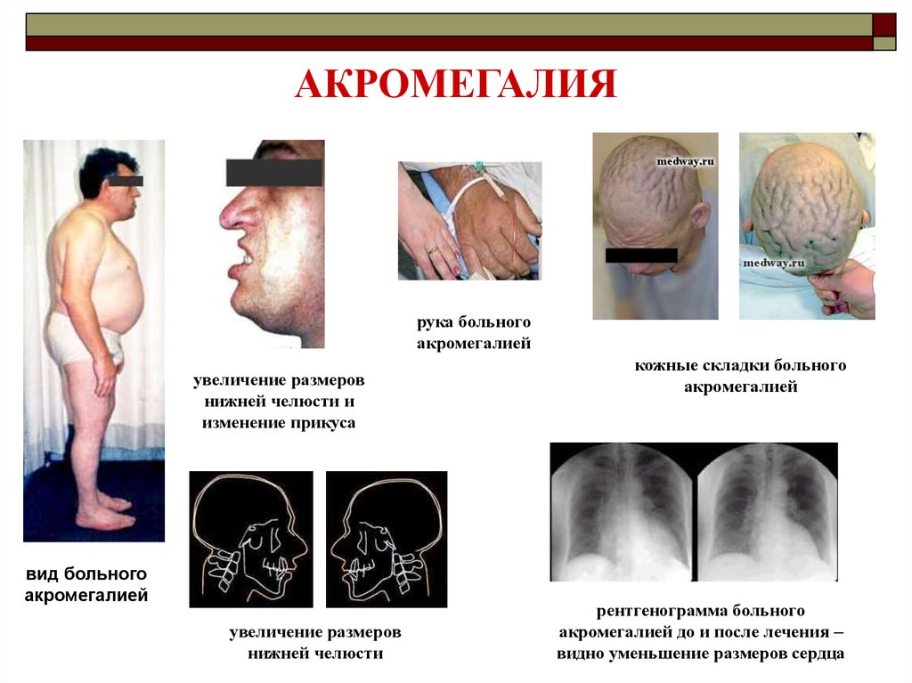 Презентация патология эндокринной системы