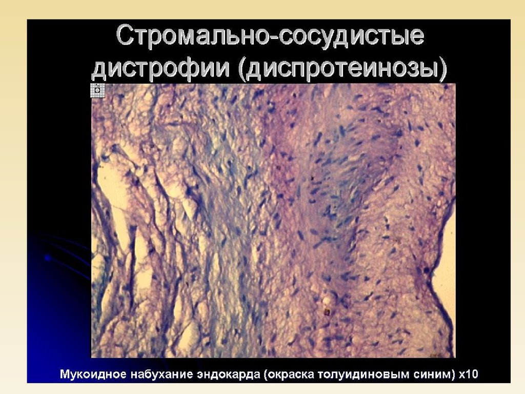 Мезенхимальные дистрофии это. Мезенхимальные жировые дистрофии патанатомия. Ожирение мезенхимальная дистрофия микроскопия. Белковые дистрофии патанатомия. Стромально-сосудистые углеводные дистрофии.