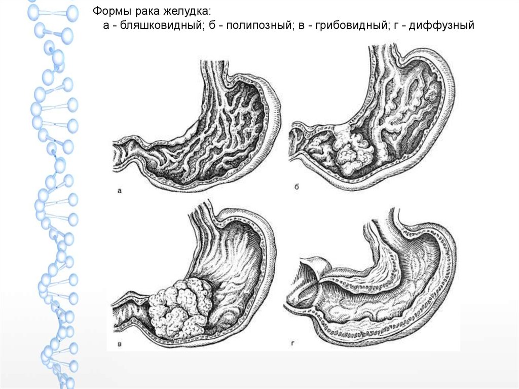 Желудок какой рак. Грибовидная опухоль желудка. Язвенно-инфильтративный тумор желудка. Язвенная болезнь желудка форма язв. Патанатомия пенетрации язвы.