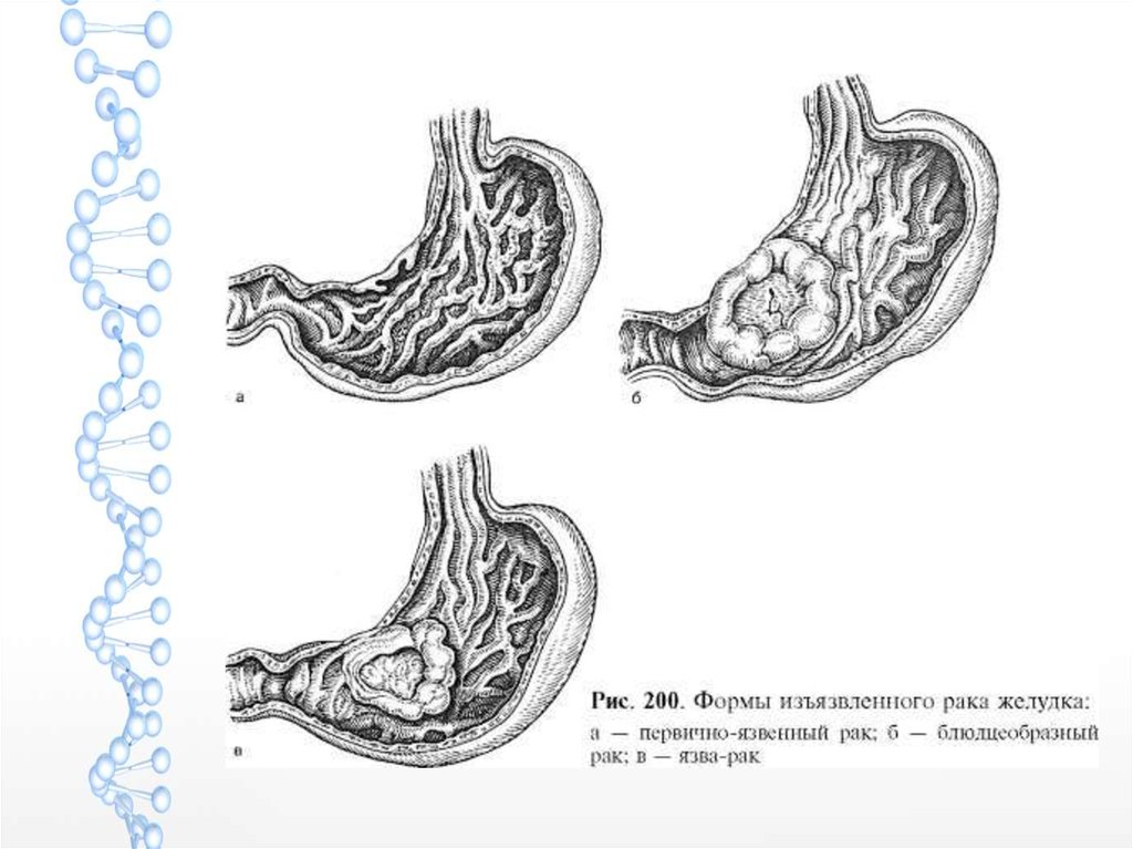 Рак желудка рисунок