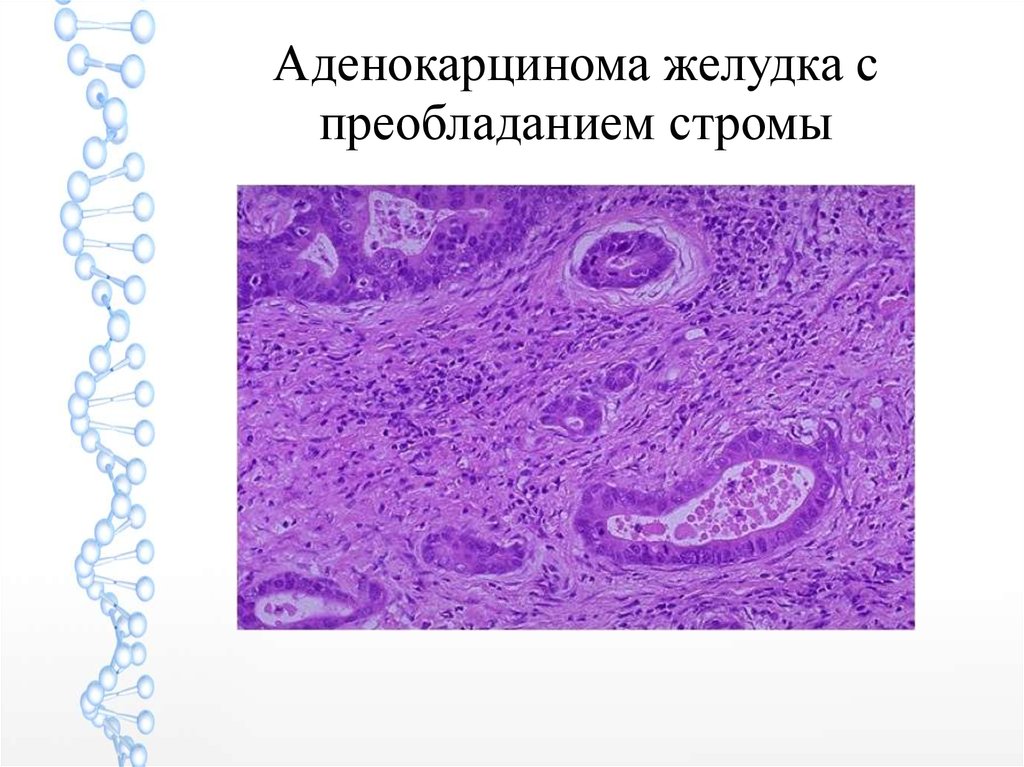 Аденокарцинома желудка микропрепарат. Аденокарцинома желудка микро. Аденокарцинома желудка микропрепарат рисунок.