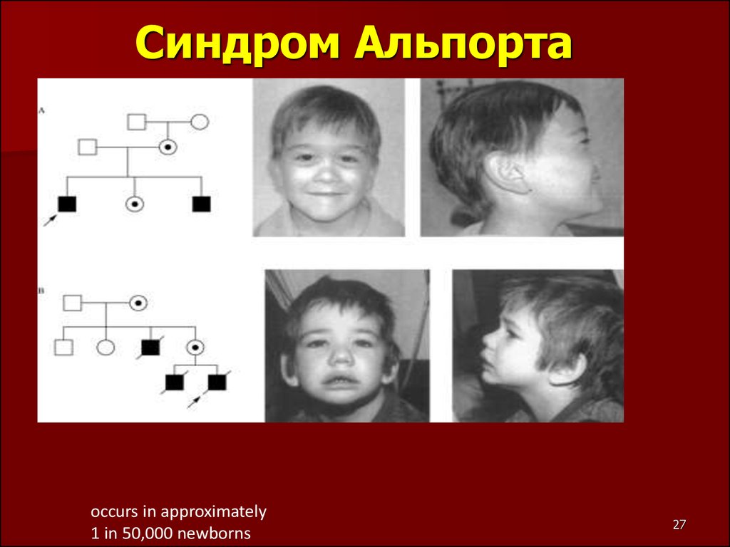 Наследственный нефрит у детей