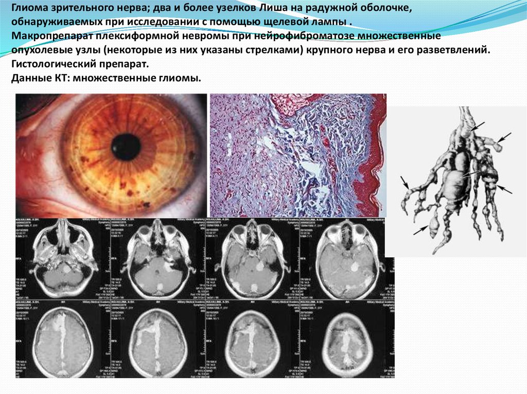 Что такое глиома. Клиника глиомы зрительного нерва:. Глиома зрительного нерва мрт. Нейрофиброматоз глиома зрительного нерва. Интракраниальная глиома зрительного нерва что это.