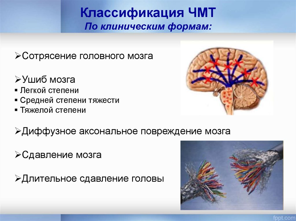 Чмт неврология презентация