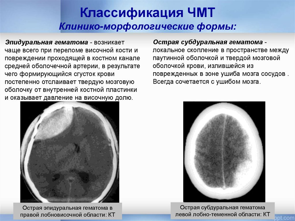 Повреждения головного мозга возникают. Субдуральная гематома рентген. Субдуральная и эпидуральная гематома. Эпидуральная гематома лобной области кт. Пластинчатая субдуральная гематома.