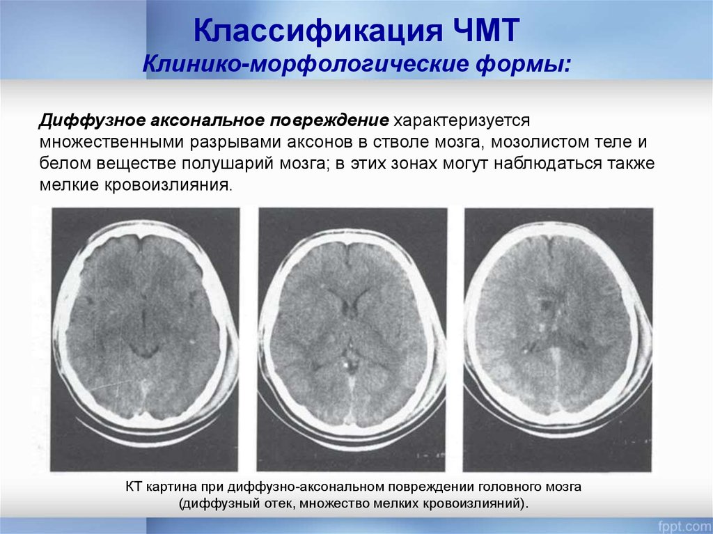 Диффузное поражение головного мозга. ЧМТ ушиб головного мозга. Диффузное аксональное повреждение мрт. Классификация ЧМТ. Классификация внутричерепных травм.