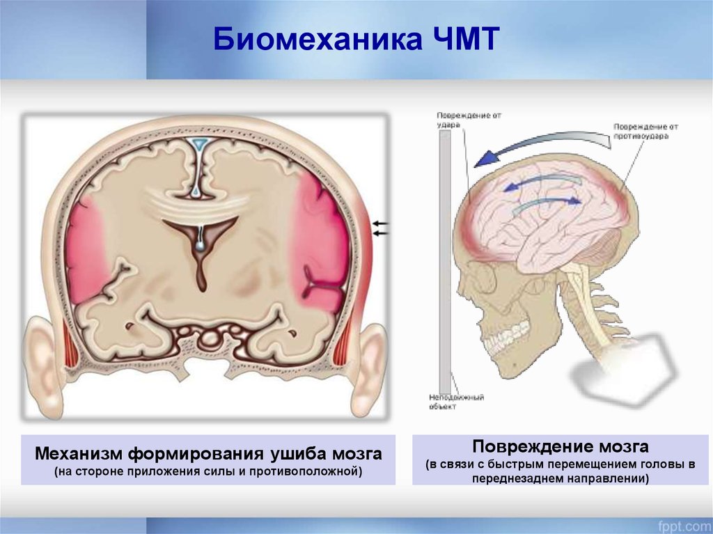 Сильная травма головы. Ушиб головного мозга механизм возникновения. ЧМТ ушиб головного мозга. Механизмы повреждения мозга. Закрытая травма головы.