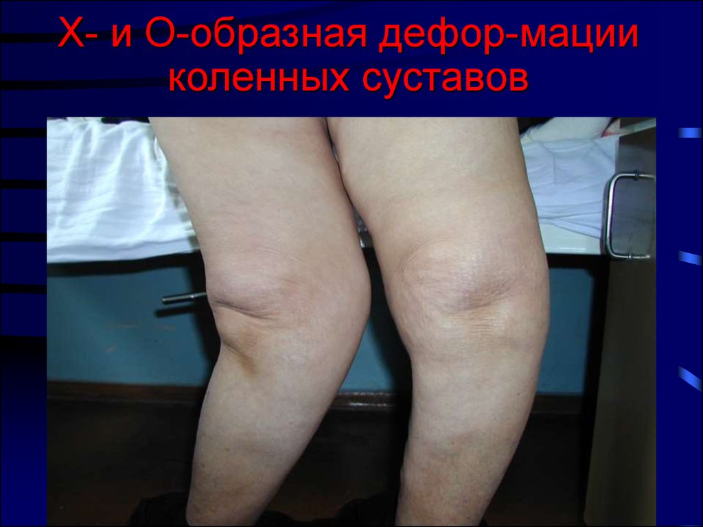 Х- и О-образная дефор-мации коленных суставов