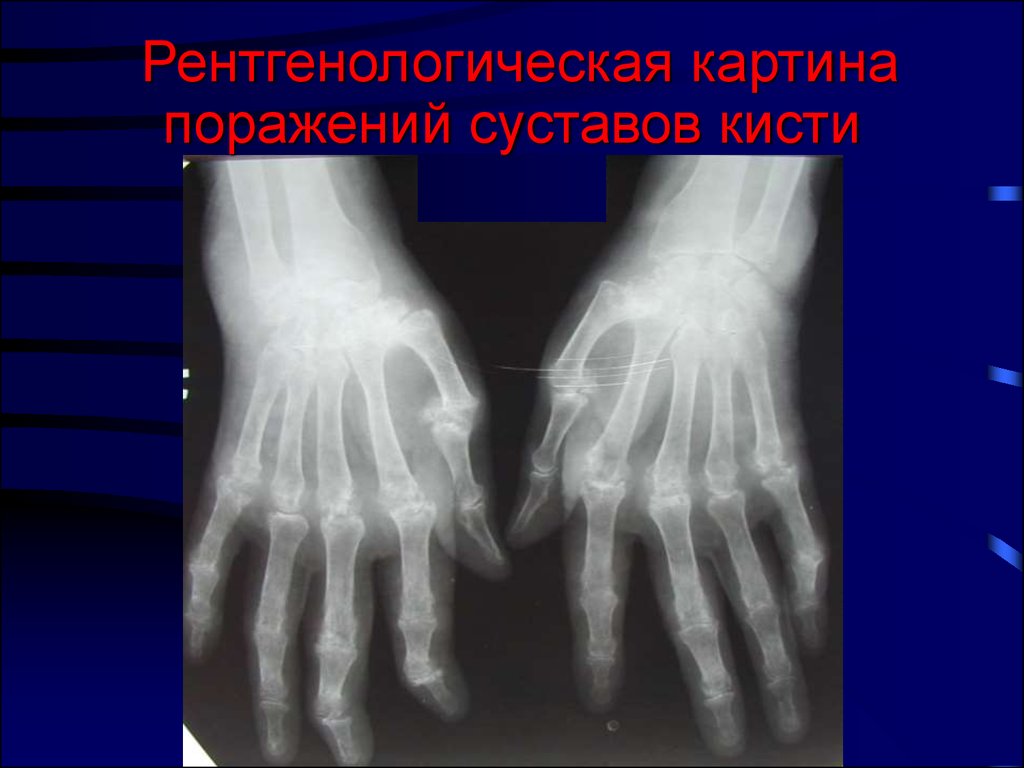 Рентгенологическая картина поражений суставов кисти