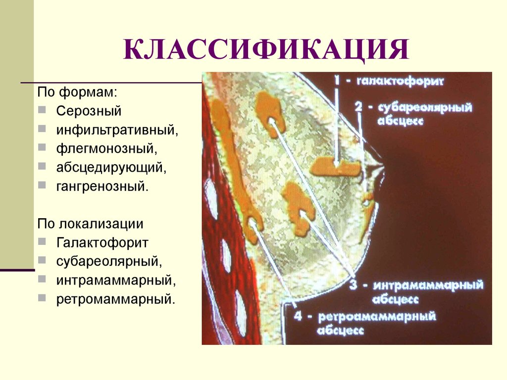 Острый гнойный мастит. Мастит классификация по локализации. Гнойный мастит классификация. Локализация абсцессов молочной железы.