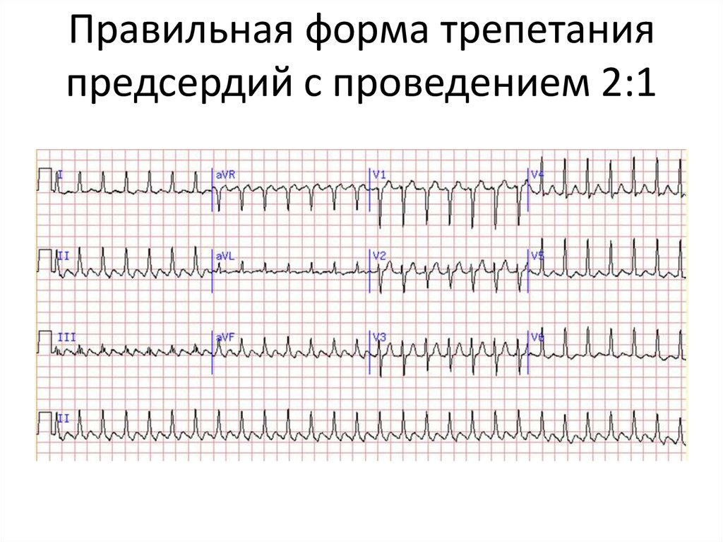 Проведение 2 1. Пароксизмальное трепетание предсердий ЭКГ. Трепетание предсердий 2 к 1 на ЭКГ. Пароксизм фибрилляции трепетания предсердий ЭКГ. Трепетание предсердий 1 к 1 на ЭКГ.