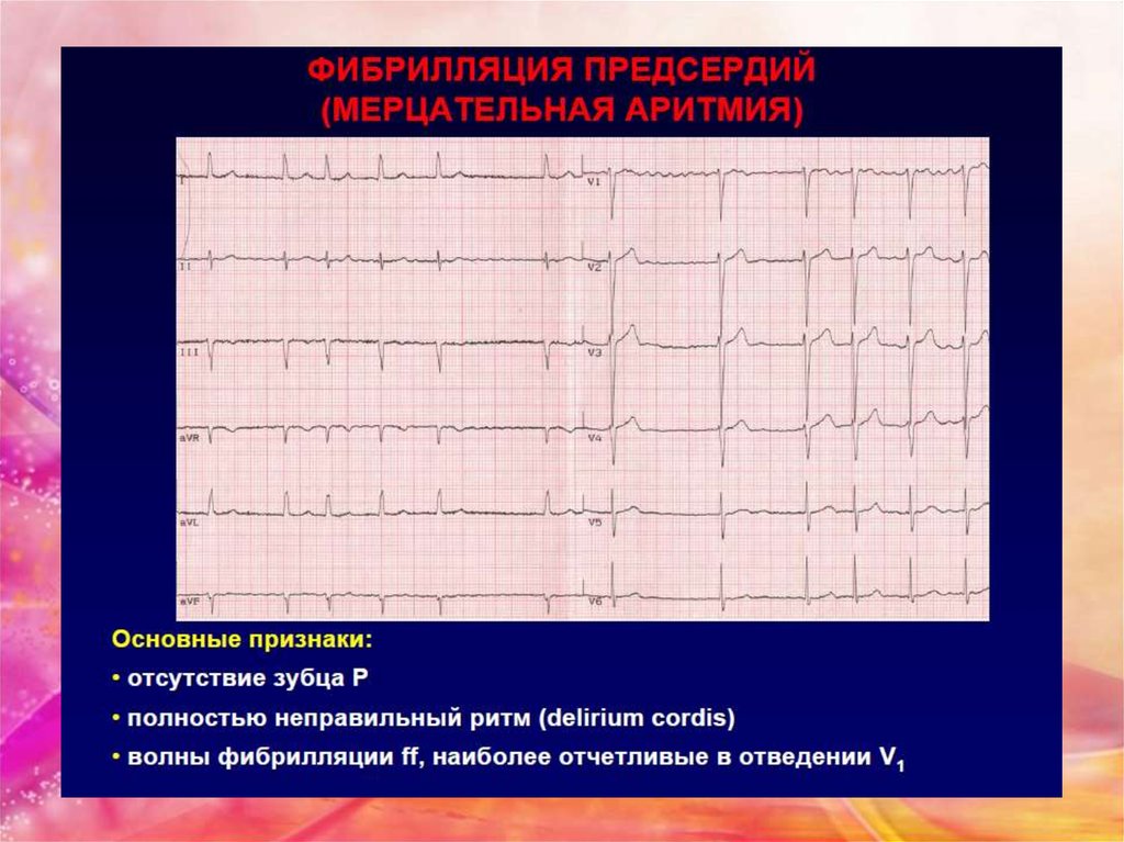 Ибс фибрилляция предсердий карта вызова