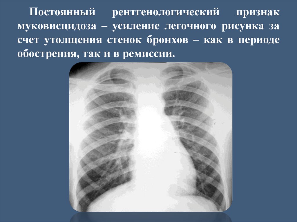 Признаки усиления легочного рисунка