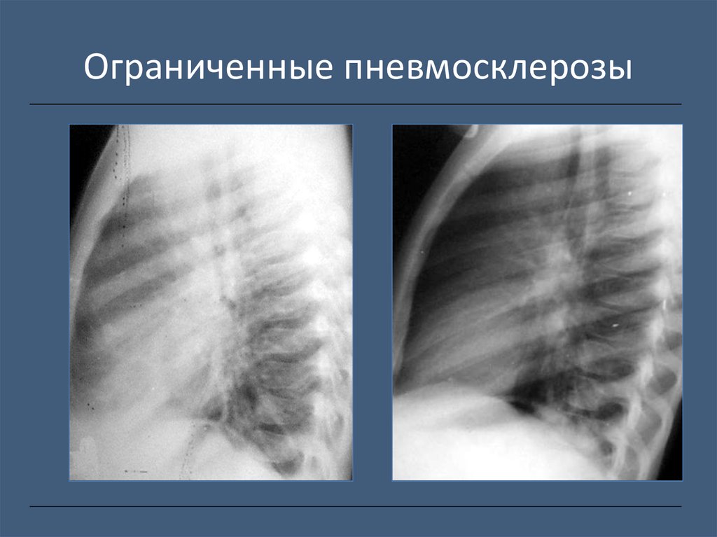 Легочный рисунок деформирован за счет пневмосклероза что это значит