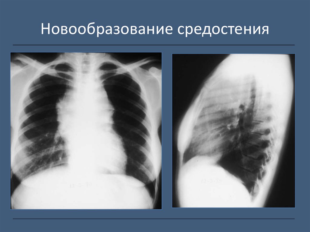 Лучевая диагностика органов средостения презентация