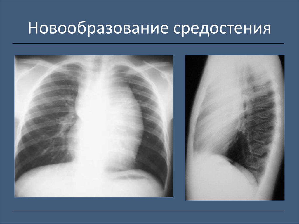 Опухоли средостения презентация