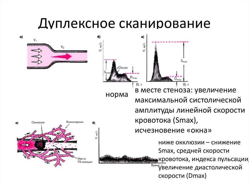 Дуплексное сканирование что это. Дуплексное сканирование. Снижение скорости кровотока. Скорость кровотока в почечных артериях. Дуплексное сканирование норма.