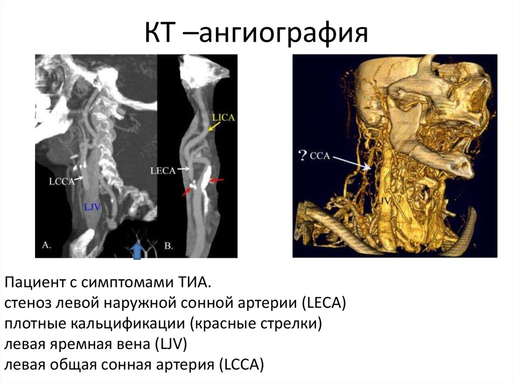 Стеноз сонно. Стеноз сонной артерии кт. Кт ангиография сонных артерий. Стеноз сонной артерии симптомы. Сужение сонной артерии симптомы.