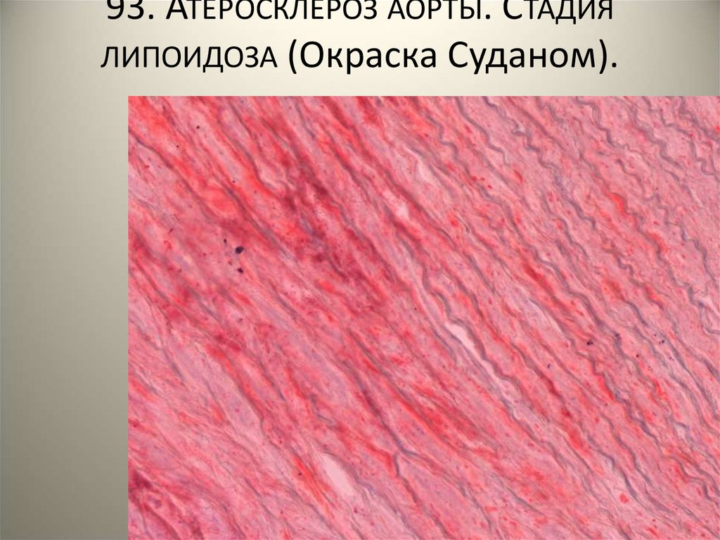 Атеросклероз аорты что это. Атеросклероз аорты атерокальциноз. Атеросклеротическая аневризма аорты микропрепарат. Атеросклероз аорты микропрепарат.