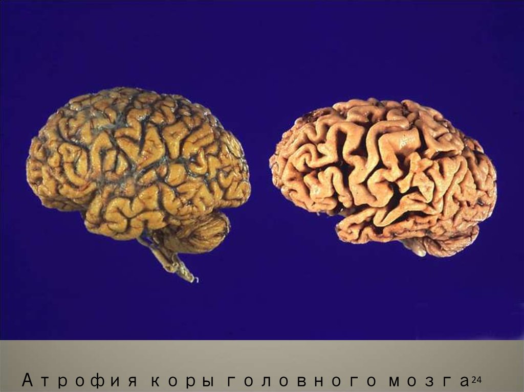 Корковые изменения головного мозга. Атрофические изменения коры головного мозга. Отмирание коры головного мозга. Атрофия коры головного мозга.