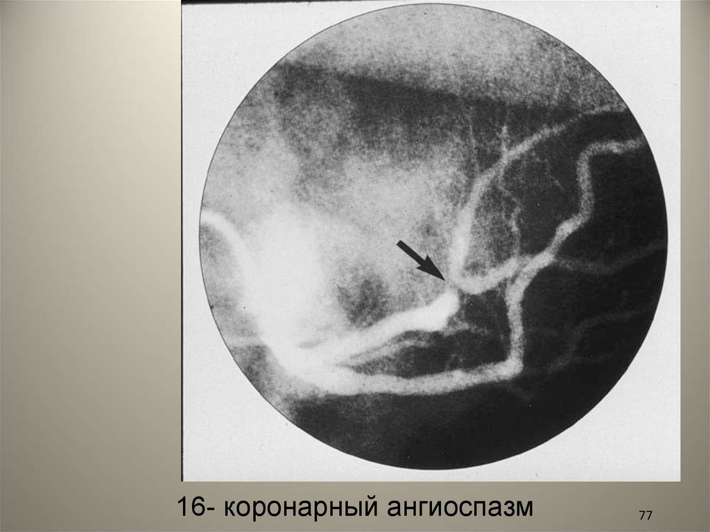 Ангиоспазм. Коронарный ангиоспазм. Ангиоспазм венечных артерий. Периферический ангиоспазм. Функциональный ангиоспазм.