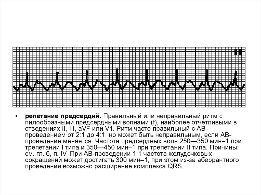 Правильный ритм. Неправильный ритм на ЭКГ. Правильный и неправильный ритм. Крупные волны f на ЭКГ. Пилообразная волна.