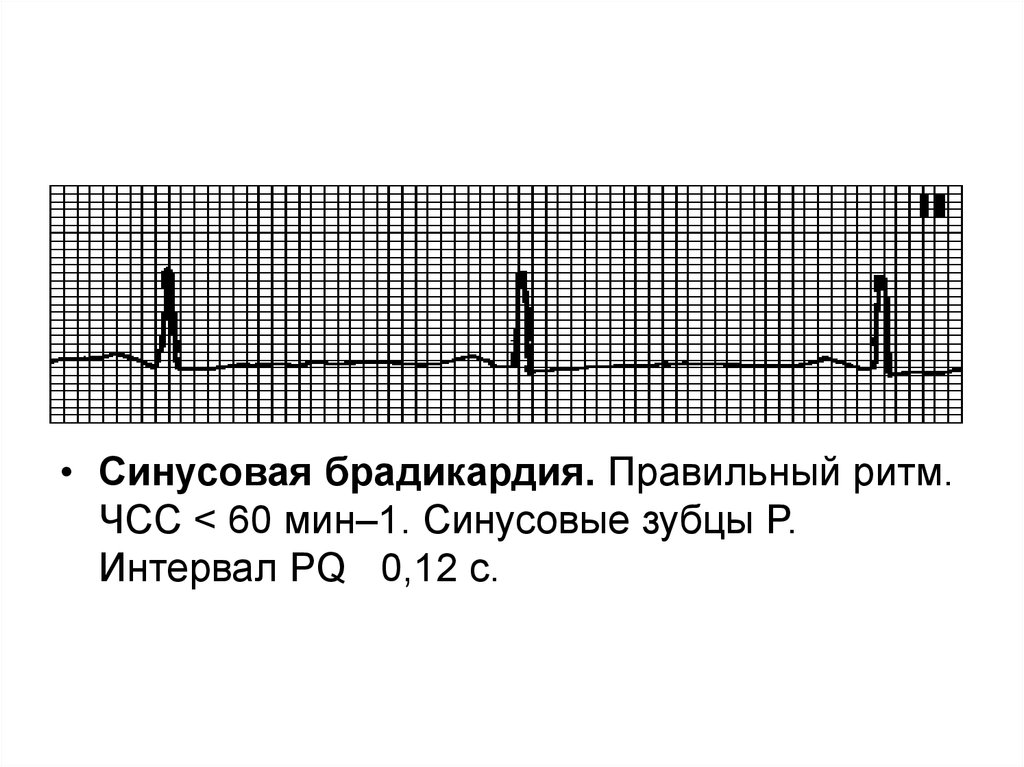 Брадикардия сердца что