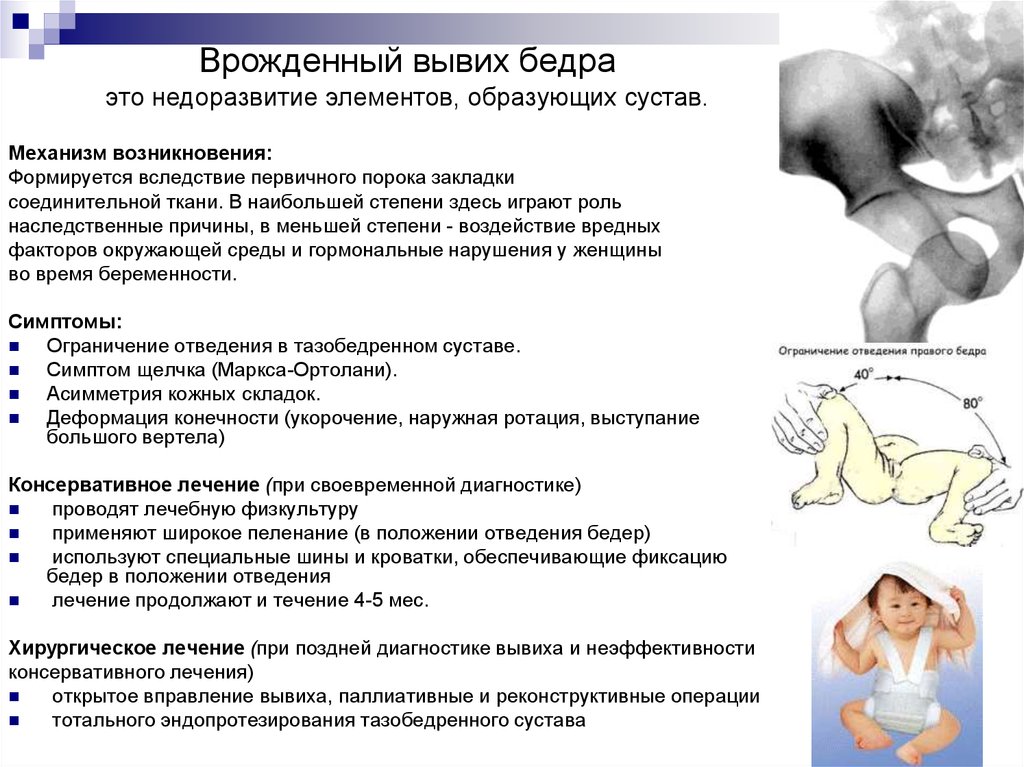 Врожденный вывих бедра. Вывихи тазобедренного сустава классификация. Диагностика врожденного подвывиха бедра. Клинические проявления врожденного вывиха бедра. Врожденный вывих бедра периоды заболевания.