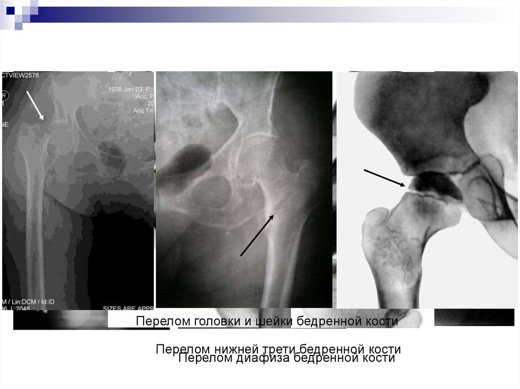 Трещина шейки. Импрессионный перелом шейки бедренной кости кт. Субкапитальный перелом головки бедренной кости. Вколоченный перелом шейки бедра рентген. Аддукционный перелом шейки бедра рентген.