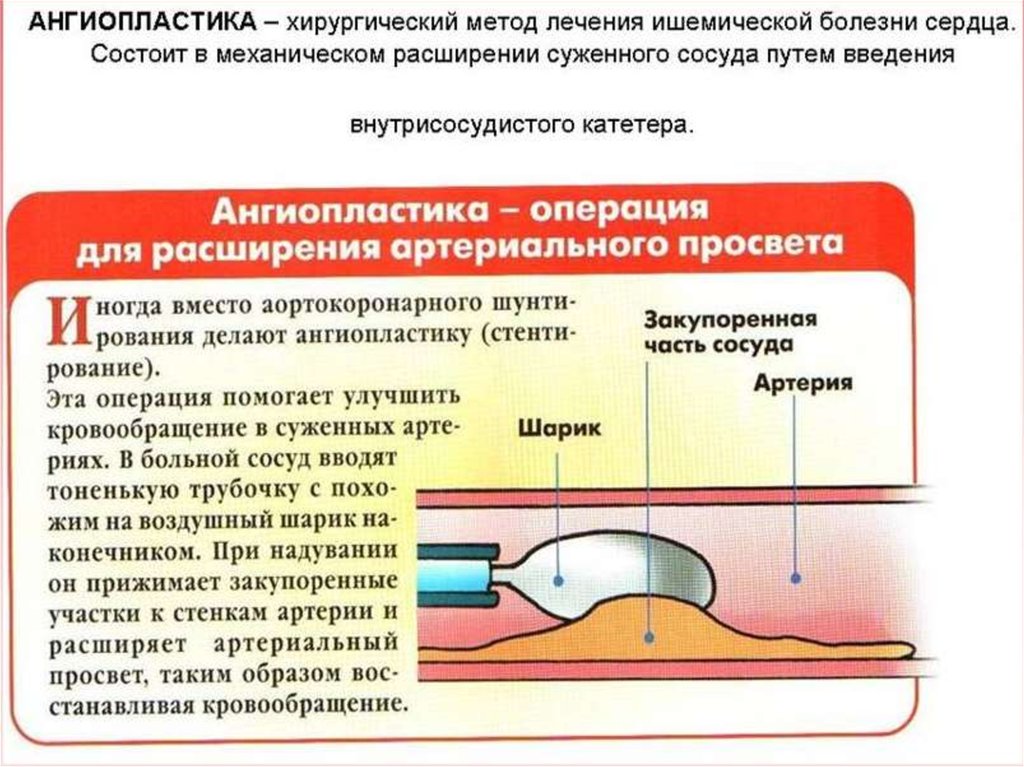 Презентация инфаркт миокарда лечение