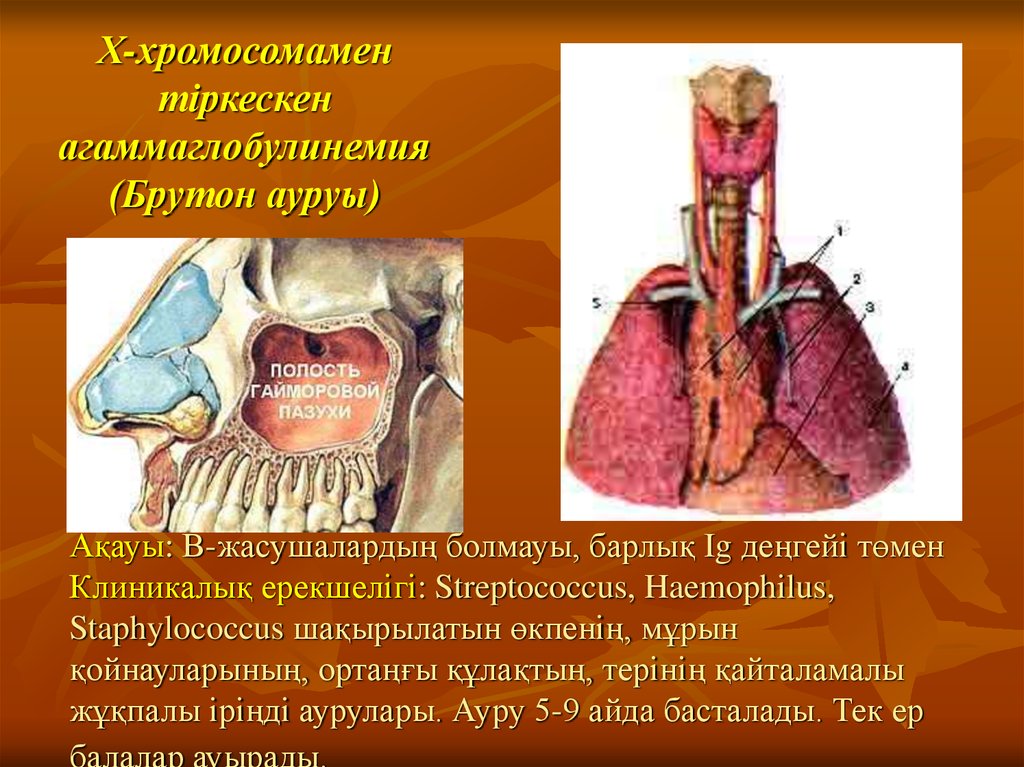 Болезнь брутона. Гипогаммаглобулинемия Брутона. Агаммаглобулинемия болезнь Брутона. Агаммаглобулинемия Брутона иммунология. Агаммаглобулинемия Брутона патогенез.