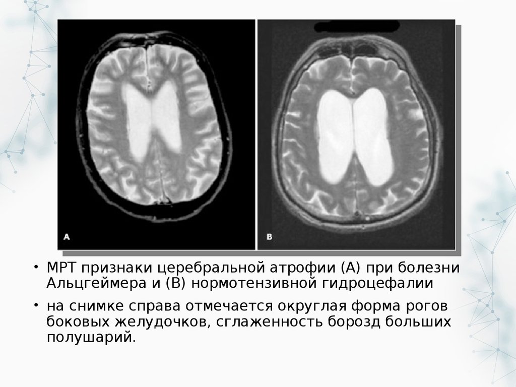 Мр картина умеренных явлений наружной заместительной гидроцефалии