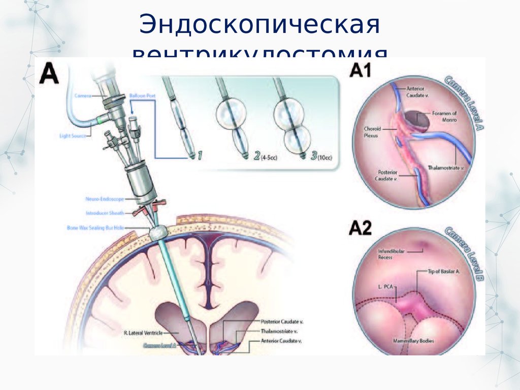 Водянка операции лечения. Эндоскопическая вентрикулоцистерностомия. Эндоскопическая вентрикулостомия III желудочка. Эндоскопическая коагуляция сосудистого сплетения. Эндоскопическая тривентрикулоцистерностомия операция.