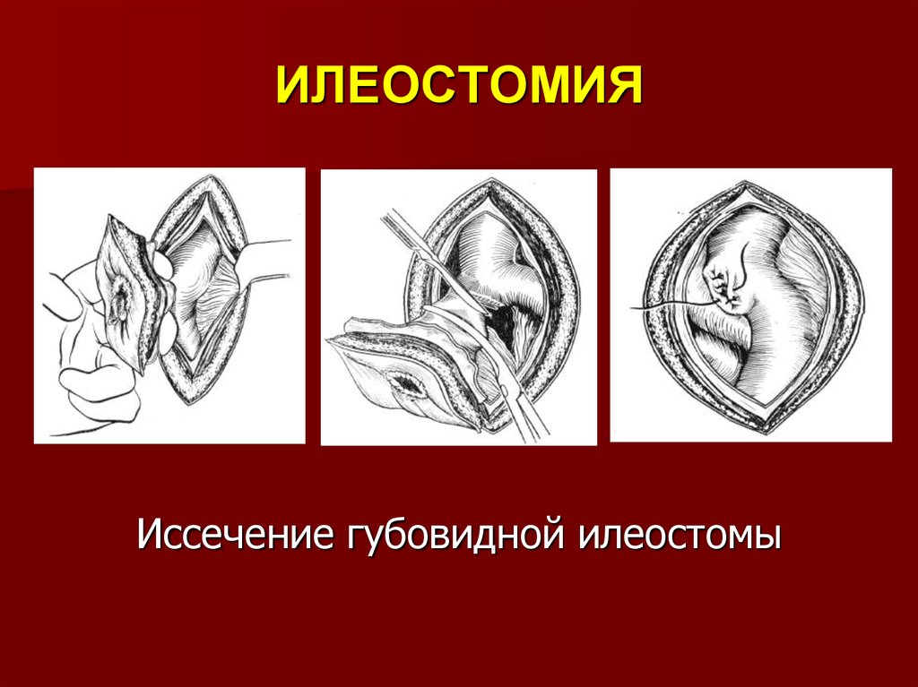 Топографическая анатомия тонкой кишки презентация