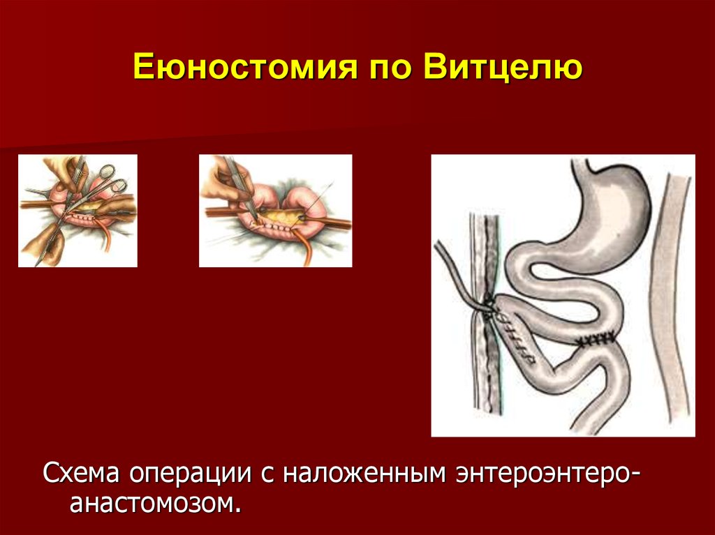 Еюностома. Еюностомия по по Витцелю. Операция Майдля еюностомия. Еюностомия питательная. Еюностомия техника операции.