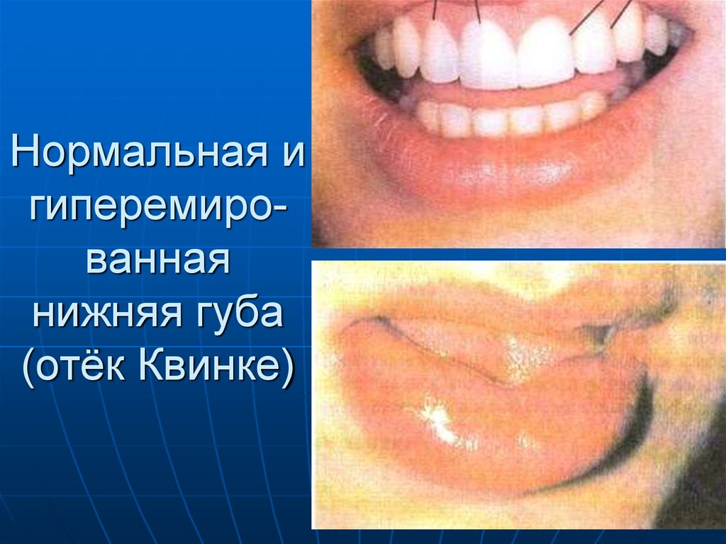 Нормальная и гиперемиро-ванная нижняя губа (отёк Квинке)