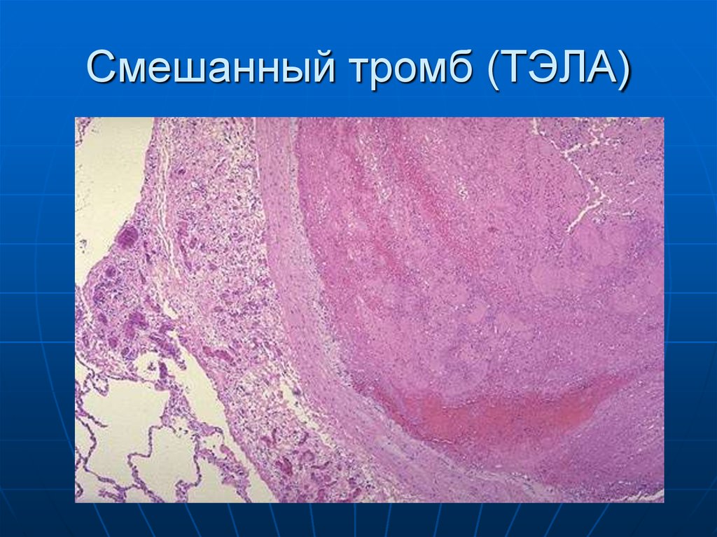 Описание тромба. Смешанный тромб артерии микропрепарат. Смешанный тромб микропрепарат. Смешанный тромб в Вене микропрепарат. Смешанный тромб макропрепарат.