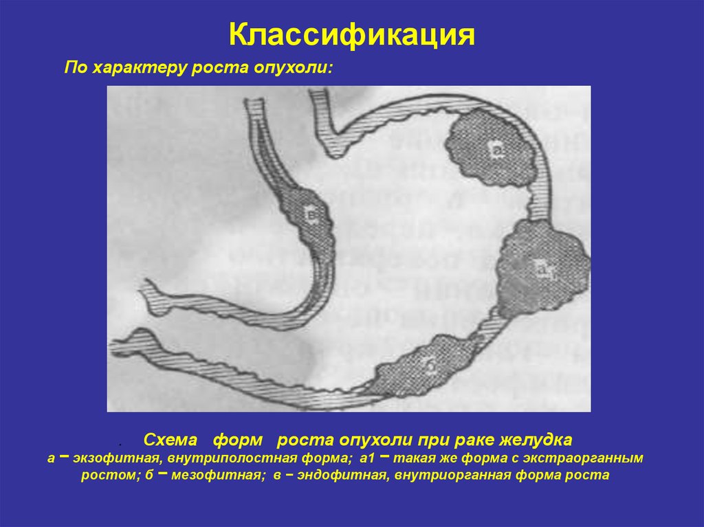 Формы роста рака