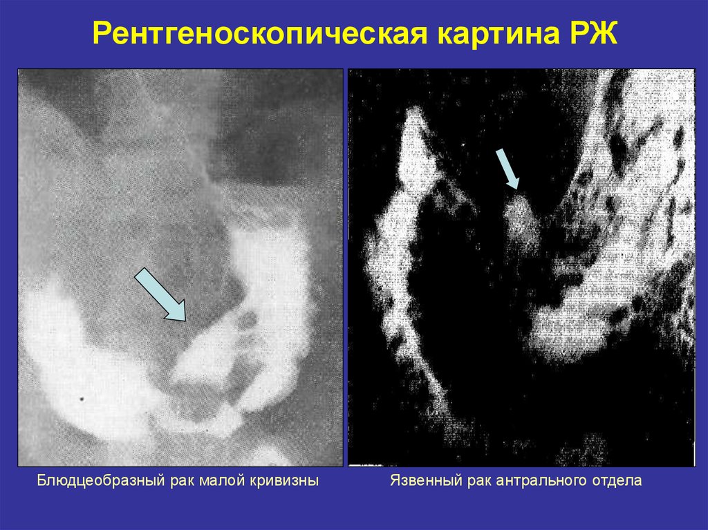 Экзофитный рак. Блюдцеобразная опухоль. Блюдцеобразный опухоль желудка. Экзофитные опухоли желудке рентген. Блюдцеобразный (рак-язва).