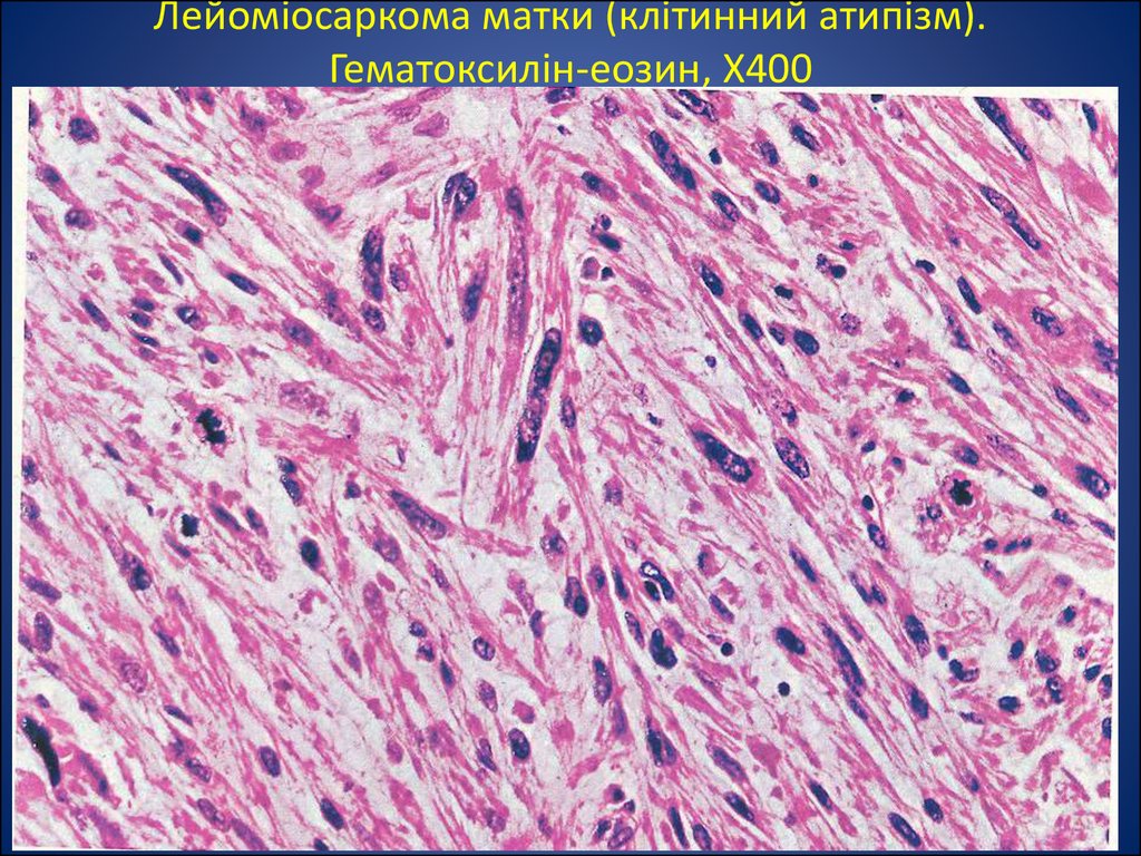Рак матки саркома. Лейомиосаркома матки гистология. Лейомиосаркома препарат патанатомия. Лейомиома матки гистология. Фибролейомиома гистология.