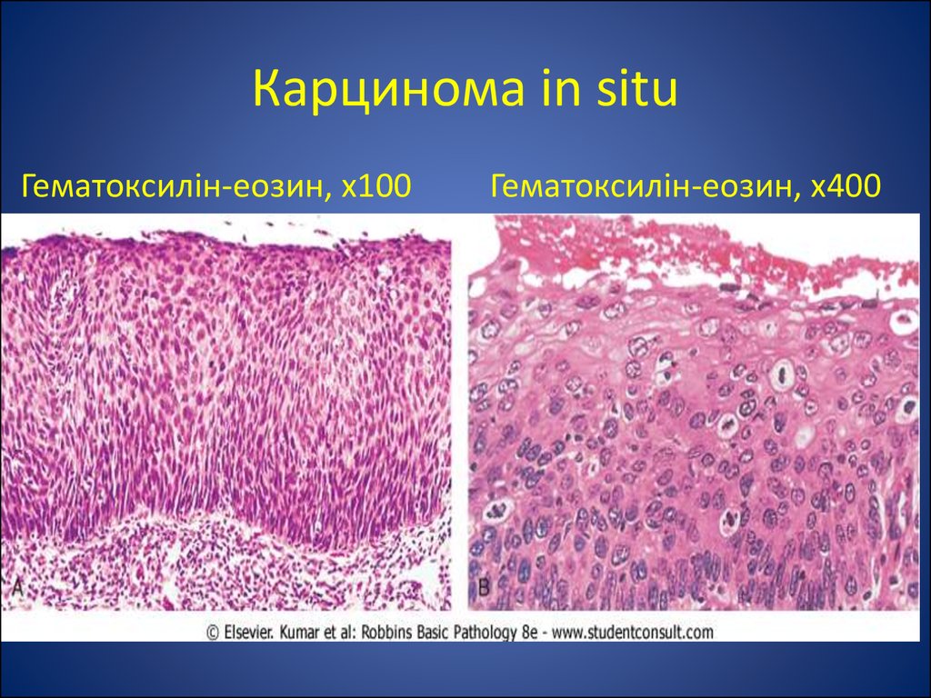 Карцинома матки in situ