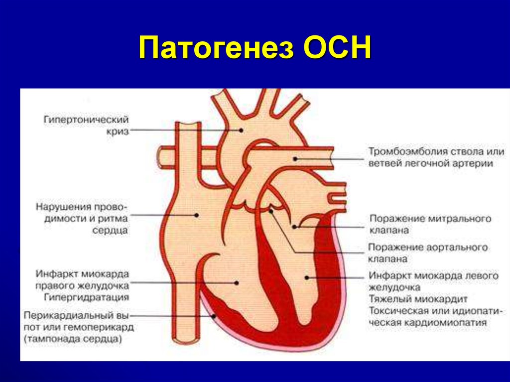 Острая сердечная недостаточность картинки для презентации