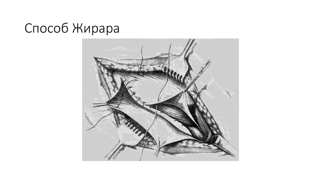 Пластика пахового канала по жирару спасокукоцкому