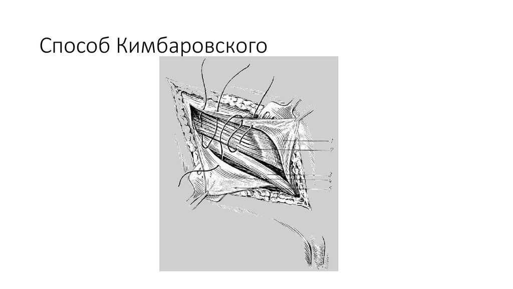 Пластика пахового канала по спасокукоцкому